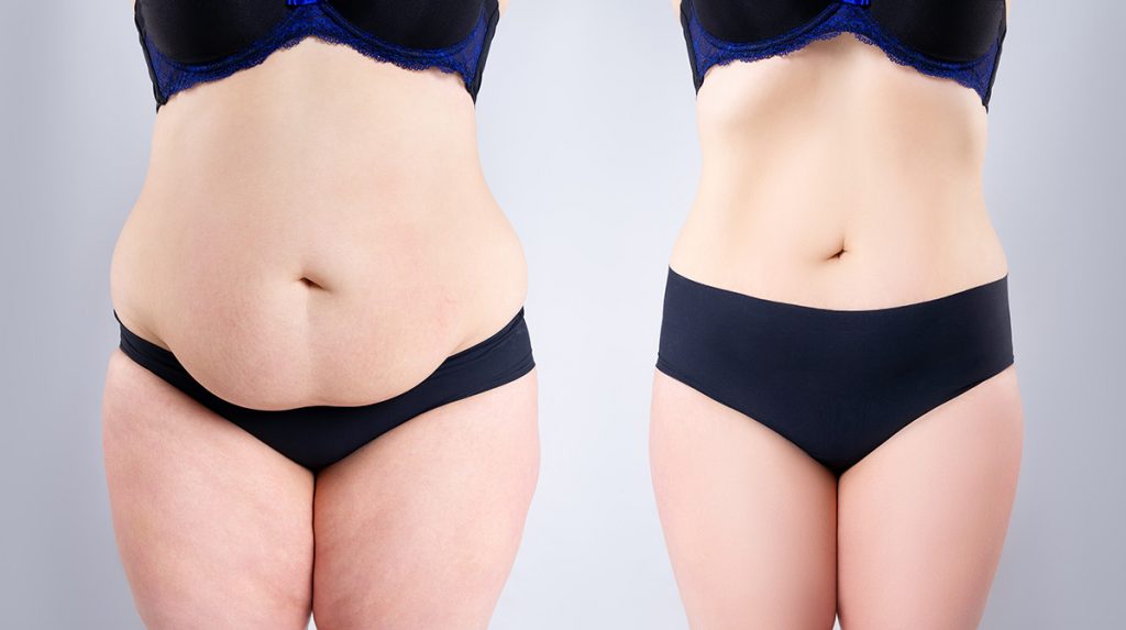 Types of tummy tuck procedures
