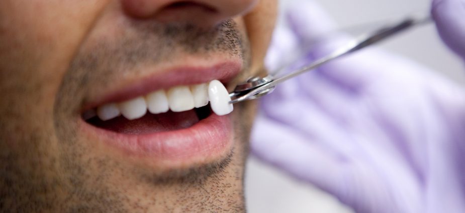 Porcelain Veneers: London’s Shortcut to Perfection